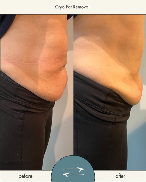Ready to see YOUR transformation? Let us help you get bikini ready with our Cryo Fat Removal treatment.
Book your Introductory Session to give it a try! Link in bio
#rogersar #pinnacleheights #cryolounge #freezeyourbunsoff #cryotherapy