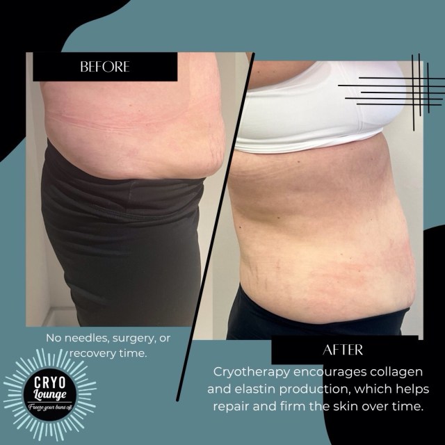 No surgery. No downtime. Just RESULTS. 🔥
This is what targeted cryotherapy can do for stubborn fat.
Ready to see changes like this?
💥 Take $100 OFF your cryotherapy treatment for a limited time
📲Book your free consultation today!
#cryolounge #freezeyourbunsoff #cryotherapy #fatreduction #cryotreatment