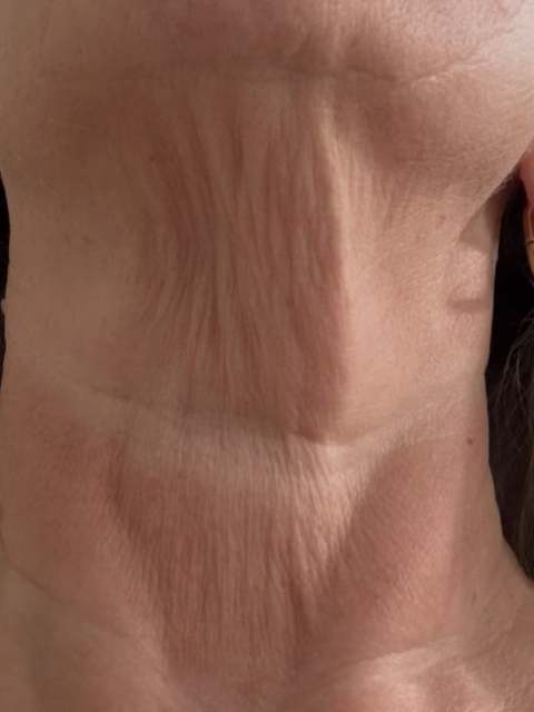 It’s officially Fibroblasting season at Cryo Lounge. Peek this before and then half way through the treatment ✨
Neck fibroblasting uses a plasma pen to create tiny, controlled heat injuries at the skin’s surface, with the goal of improving the appearance of fine lines and loose, crepey skin as it heals.
Thinking about treatment before the holiday season? Now is the time to book your consultation and allow time for healing—not squeeze it in right before an event.
📍 Cryo Lounge | Rogers, AR
📲 DM “NECK” to learn more and schedule.
Results vary. Healing time and careful aftercare are required. Not suitable for every skin types.